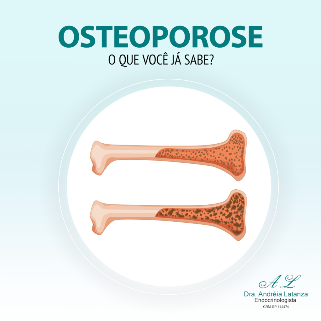 Osteoporose - o que você já sabe?
